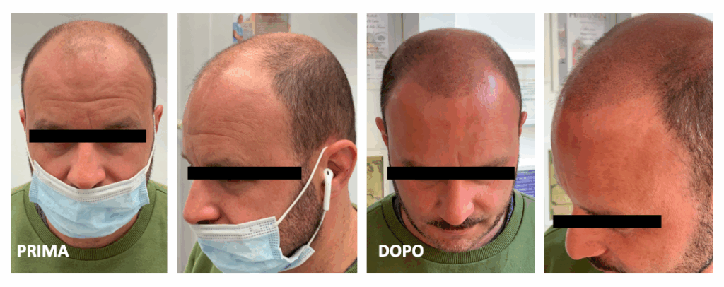 TRICO RASATO PRIMA E DOPO10